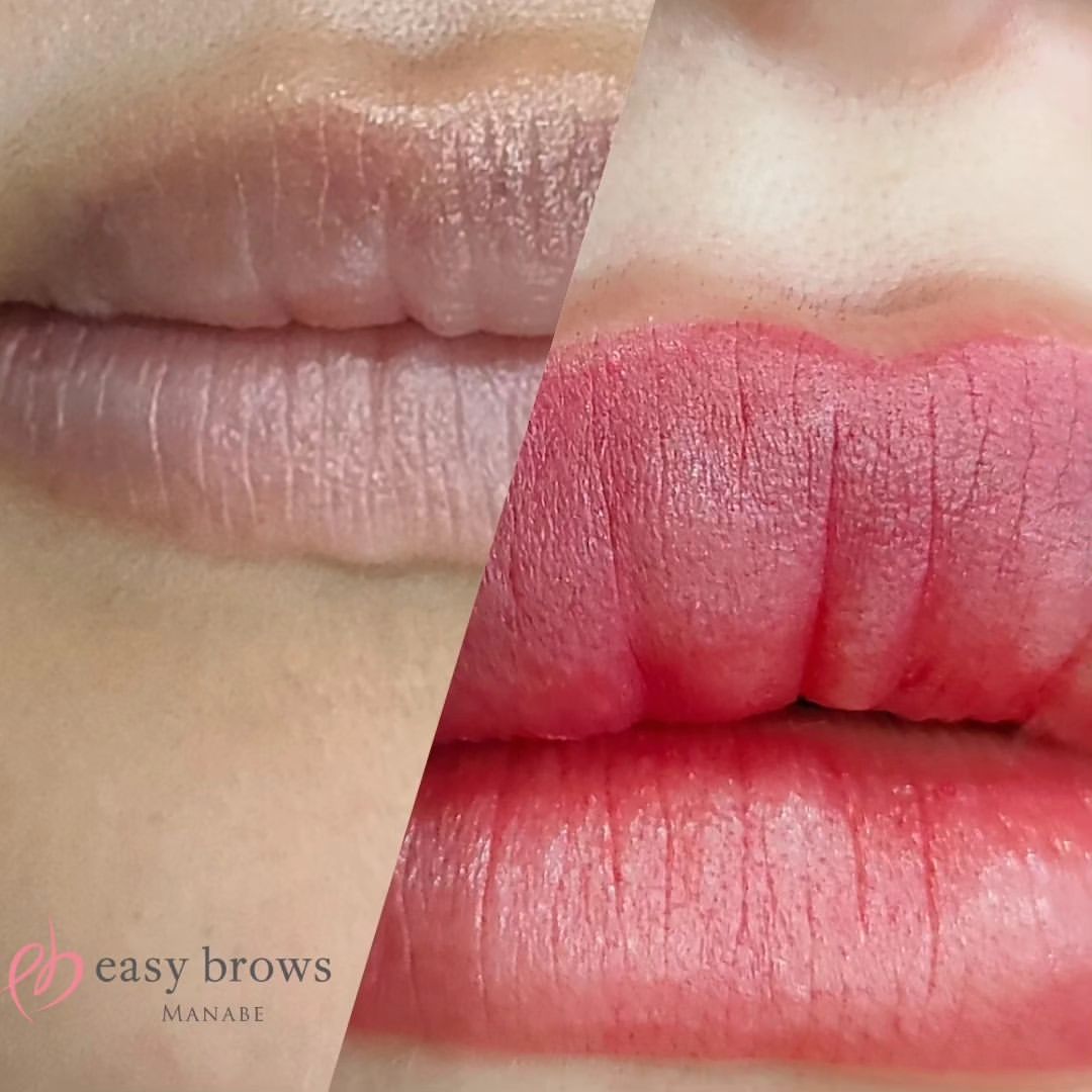 リップ 症例写真1