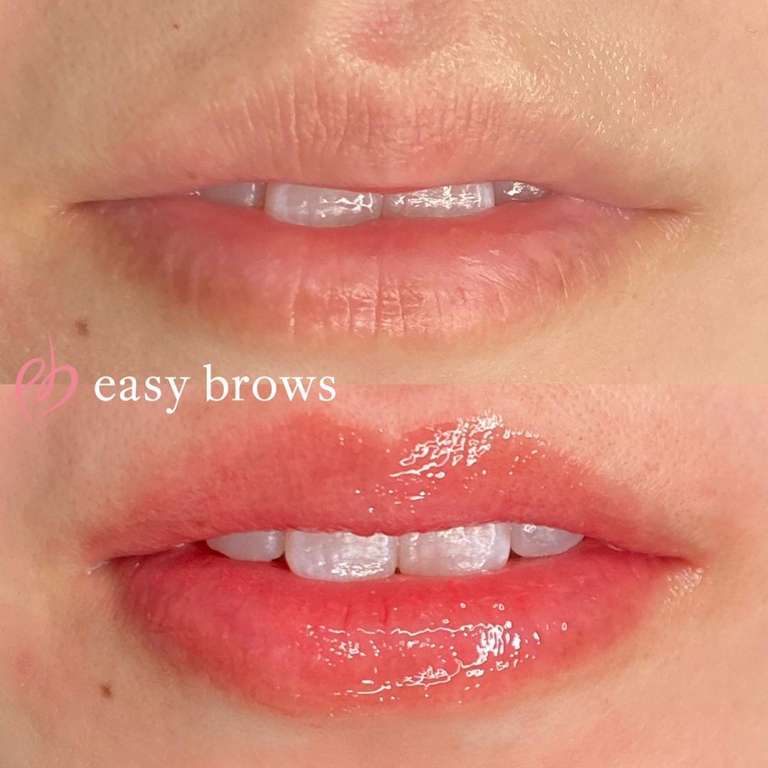 リップ 症例写真2