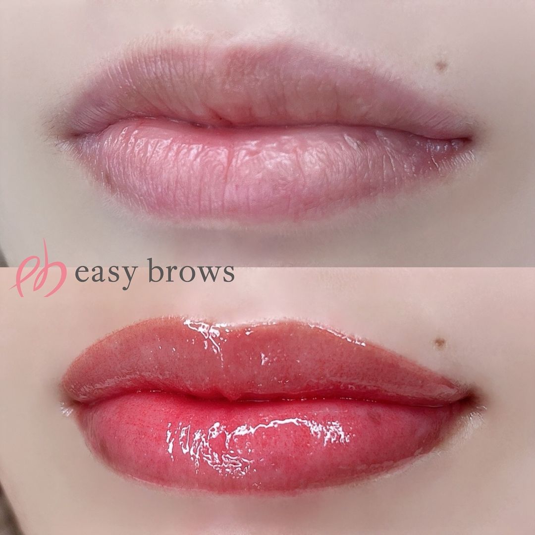 リップ 症例写真3