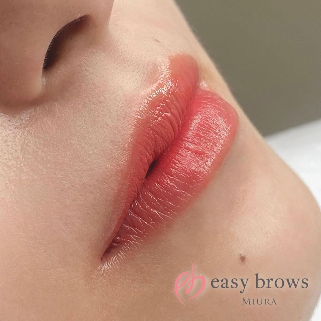 リップ 症例写真5