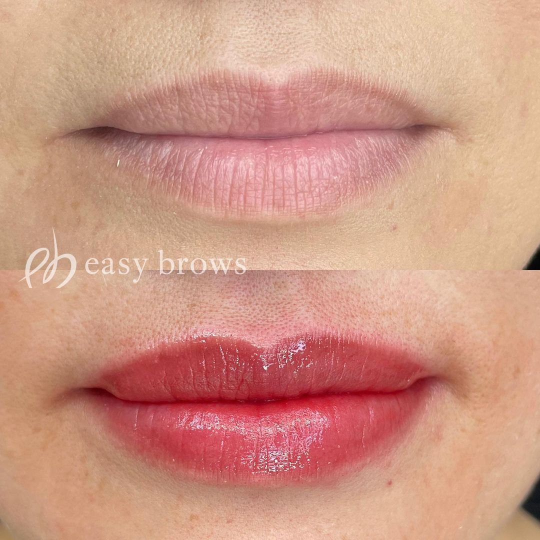 リップ 症例写真6