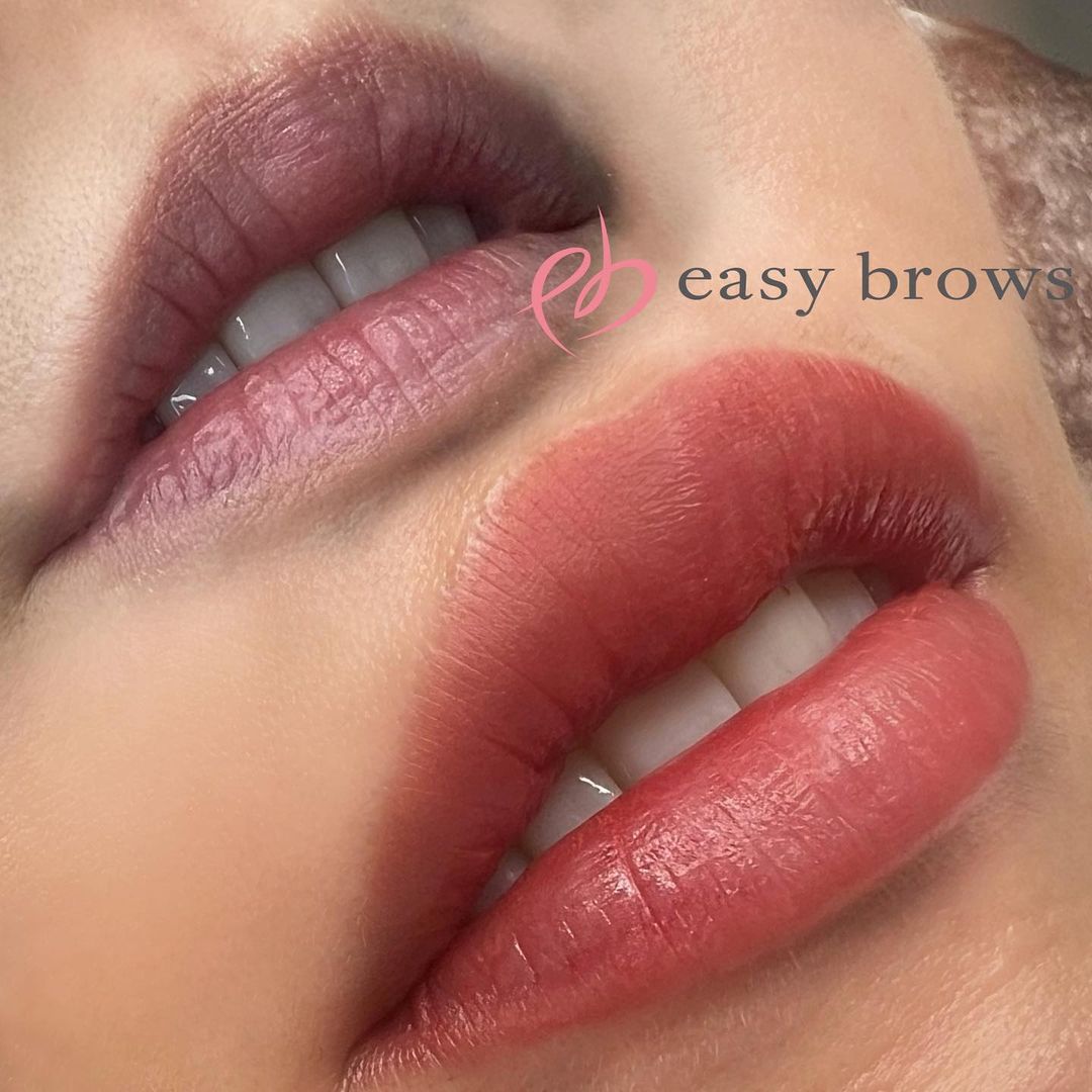 リップ 症例写真7