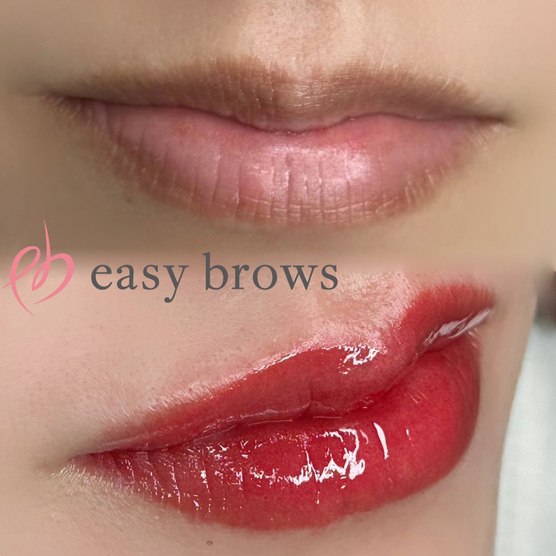 リップ 症例写真9